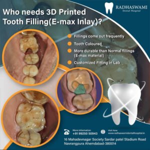 3D Printed Tooth Filling (E-max Inlay) benefits and treatment visuals at Radhaswami Dental Clinic in Ahmedabad