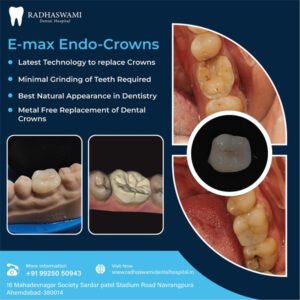 E-max Endo-Crowns dental solution – Radhaswami Dental Clinic in Ahmedabad
