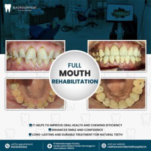 Full Mouth Rehabilitation before and after treatment results at Radhaswami Dental Clinic in Ahmedabad