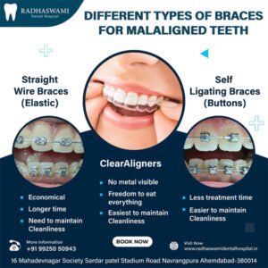Types of dental braces – ClearAligners, Straight Wire Braces, and Self-Ligating Braces by Radhaswami Dental Clinic in Ahmedabad