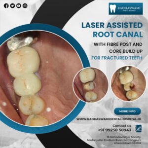 Laser Assisted Root Canal treatment with fibre post and core build-up for fractured teeth – dental procedure example from Radhaswami Dental Clinic in Ahmedabad