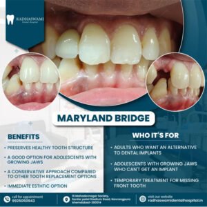 Maryland Bridge dental solution for missing front tooth with benefits and target patients at Radhaswami Dental Clinic in Ahmedabad
