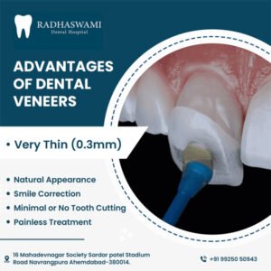 Dental veneers benefits – natural look and painless smile correction by Radhaswami Dental Clinic in Ahmedabad