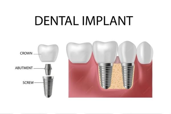 TOP7benefits of dental implant (1)